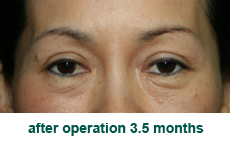 plastic-surgery-blepharoplasty